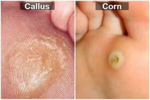 Callous and corns