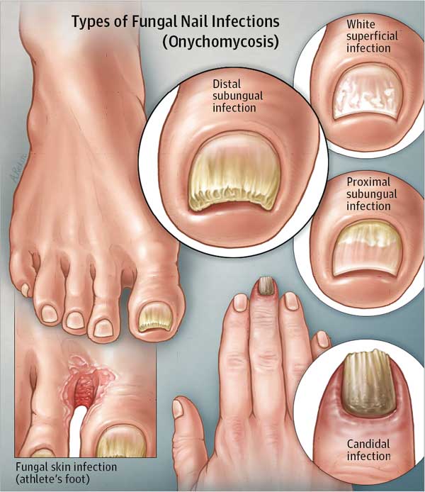 Astro Medical Aesthetic - Nail Fungus