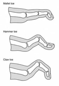 Claw, Hammer & Mallet Toes