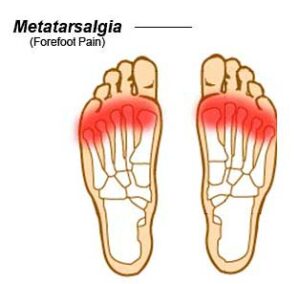 forefoot pain